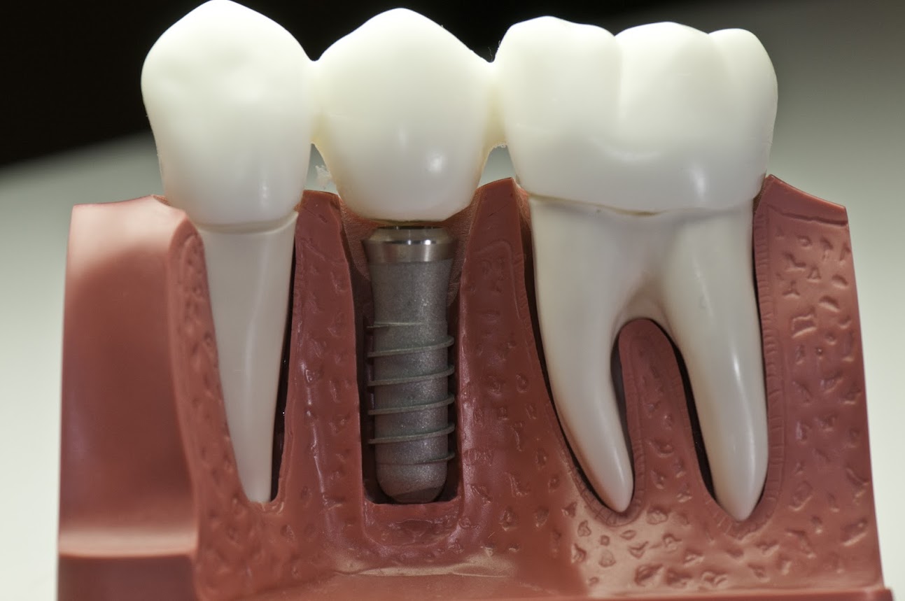 This model shows the teeth have been capped and the stainless pin in