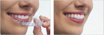 invisible braces invisible braces and clear teeth aligners