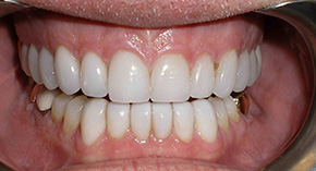 - MANGO DENTAL Dental Crown Restoration