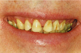 excessive-wear-yellow