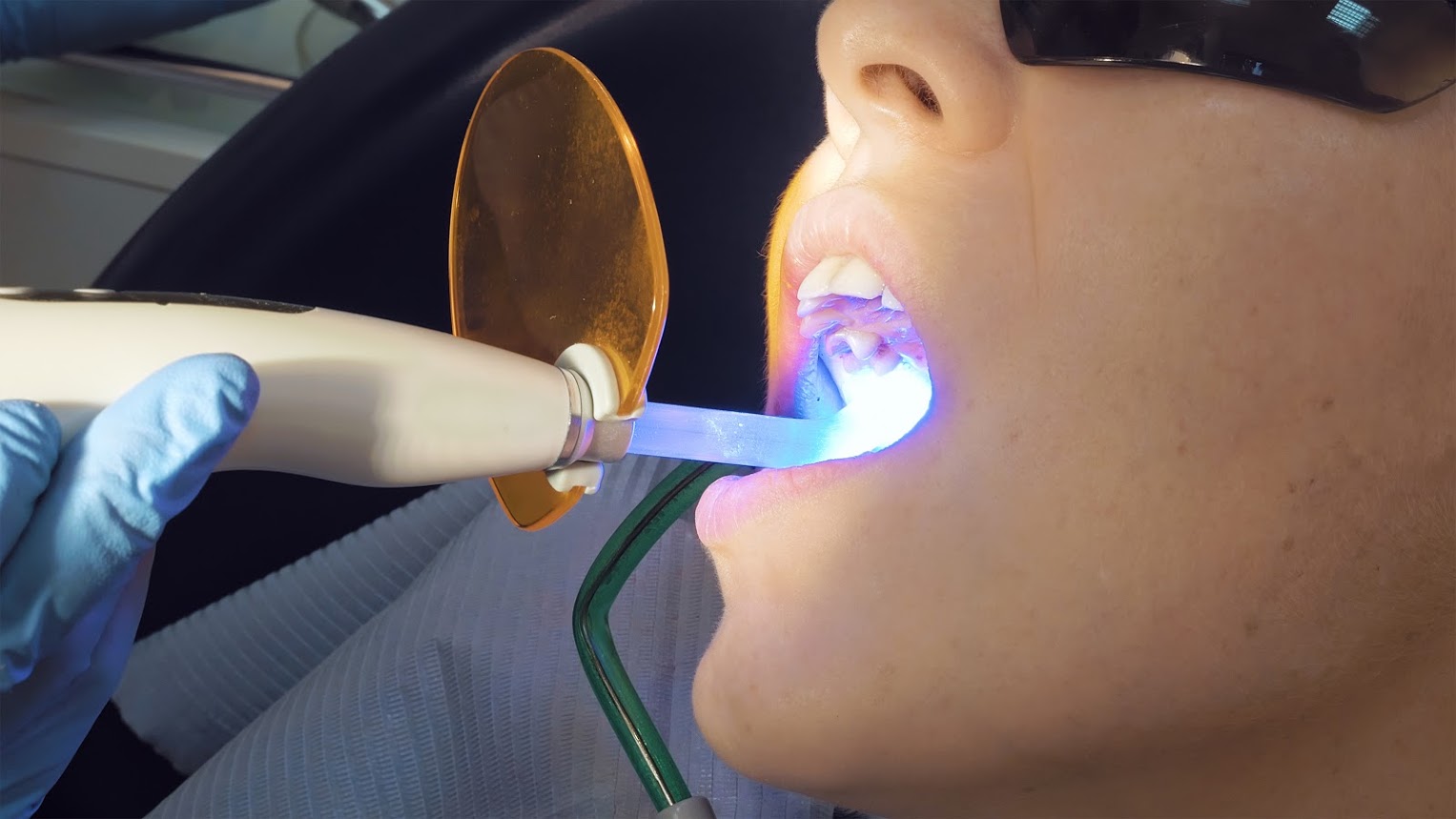 Curing Light for Fillings