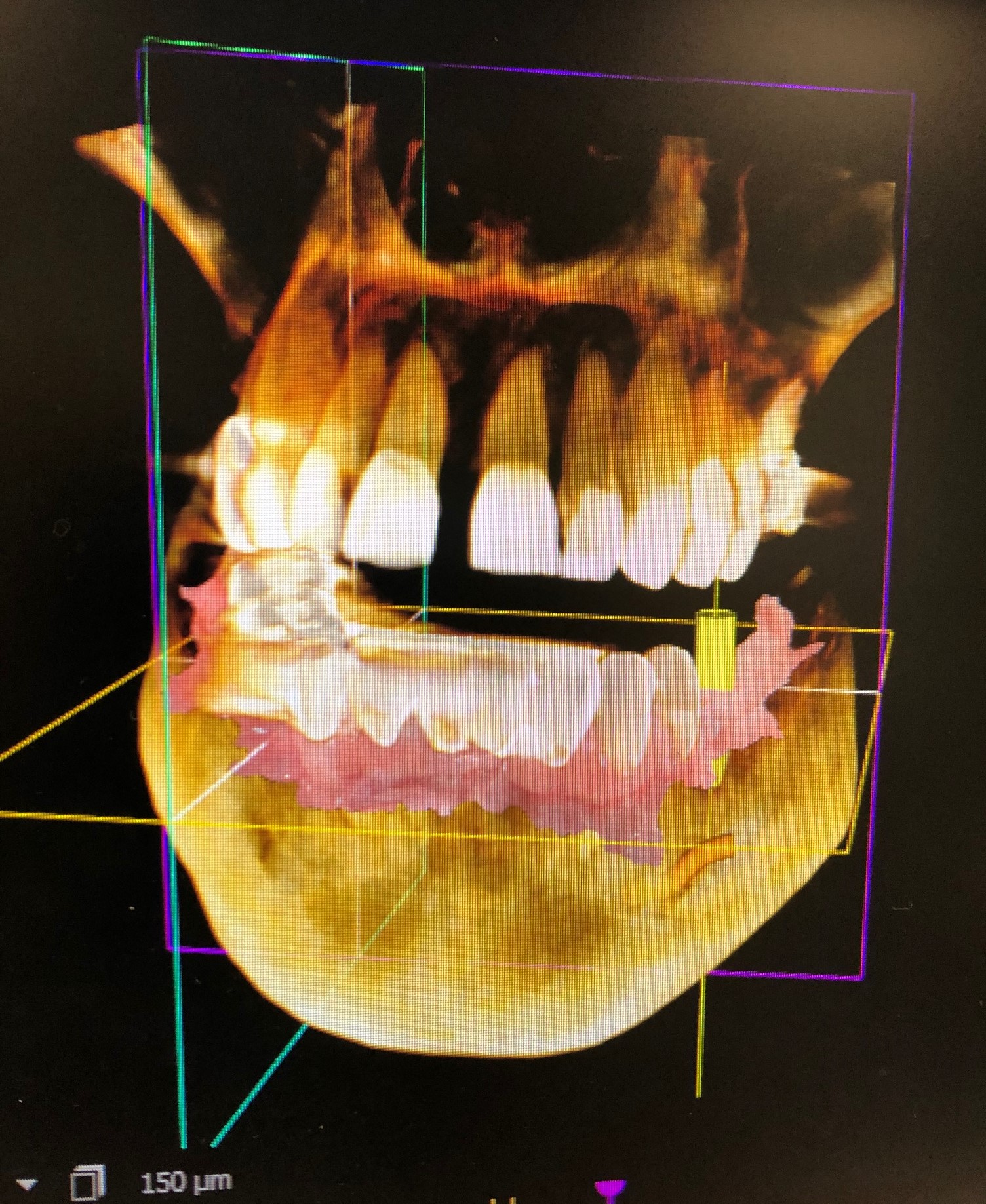 3D Imaging for Dental Implants