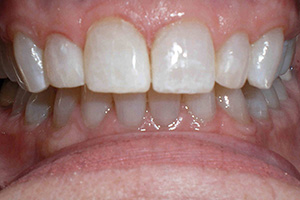 Bonding restoration of teeth