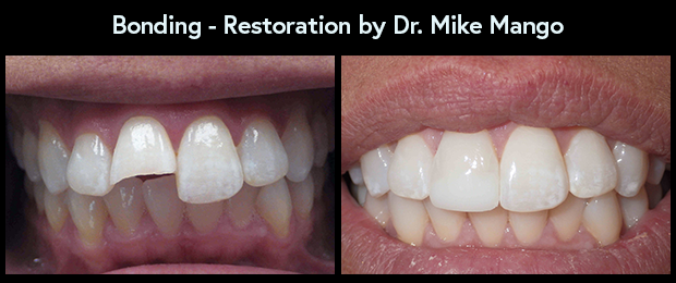 Dental Bonding by Dr. Mike Mango at Mango Dental, a dentist in Greensboro, NC