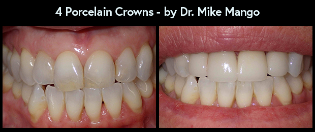 Porcelain Dental Crowns by Dr. Mike Mango, a dentist in Greensboro, NC