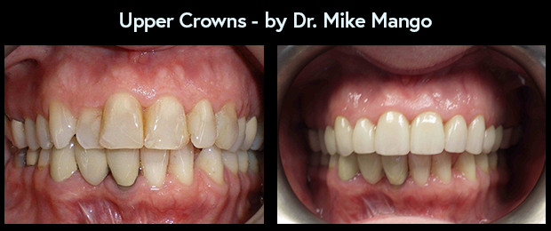 Dental Crowns by Dr. Mike Mango, a dentist in Greensboro, NC