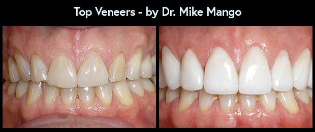 Veneers by Dr. Mike Mango, a top dentist in Greensboro, NC