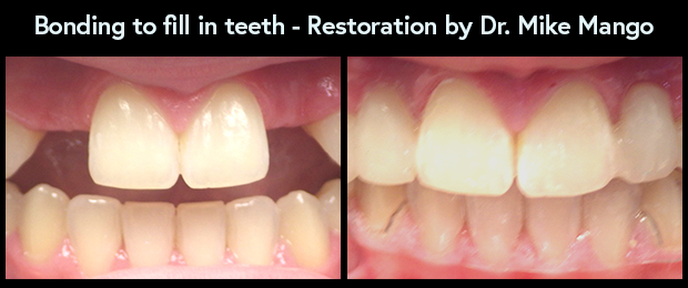 Dentist bonding to fill in missing teeth. Restoration by Dr. Mike Mango