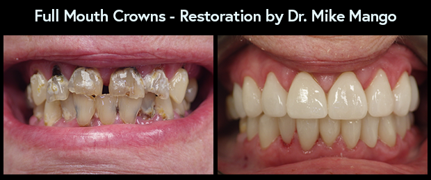 Full mouth restoration with dental crowns done by Dr. Mike Mango, a top-rated dentist in Greensboro, NC