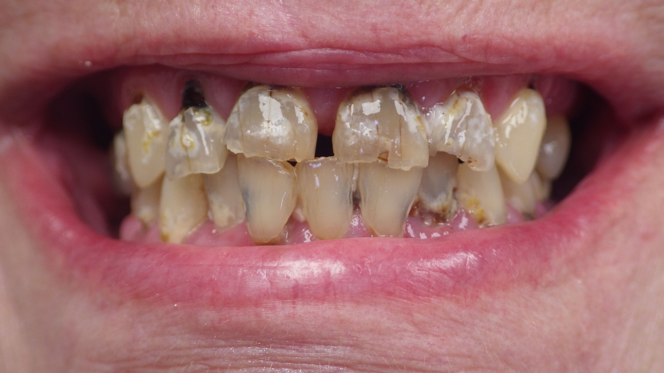 Tooth decay before dental services in Greensboro, NC