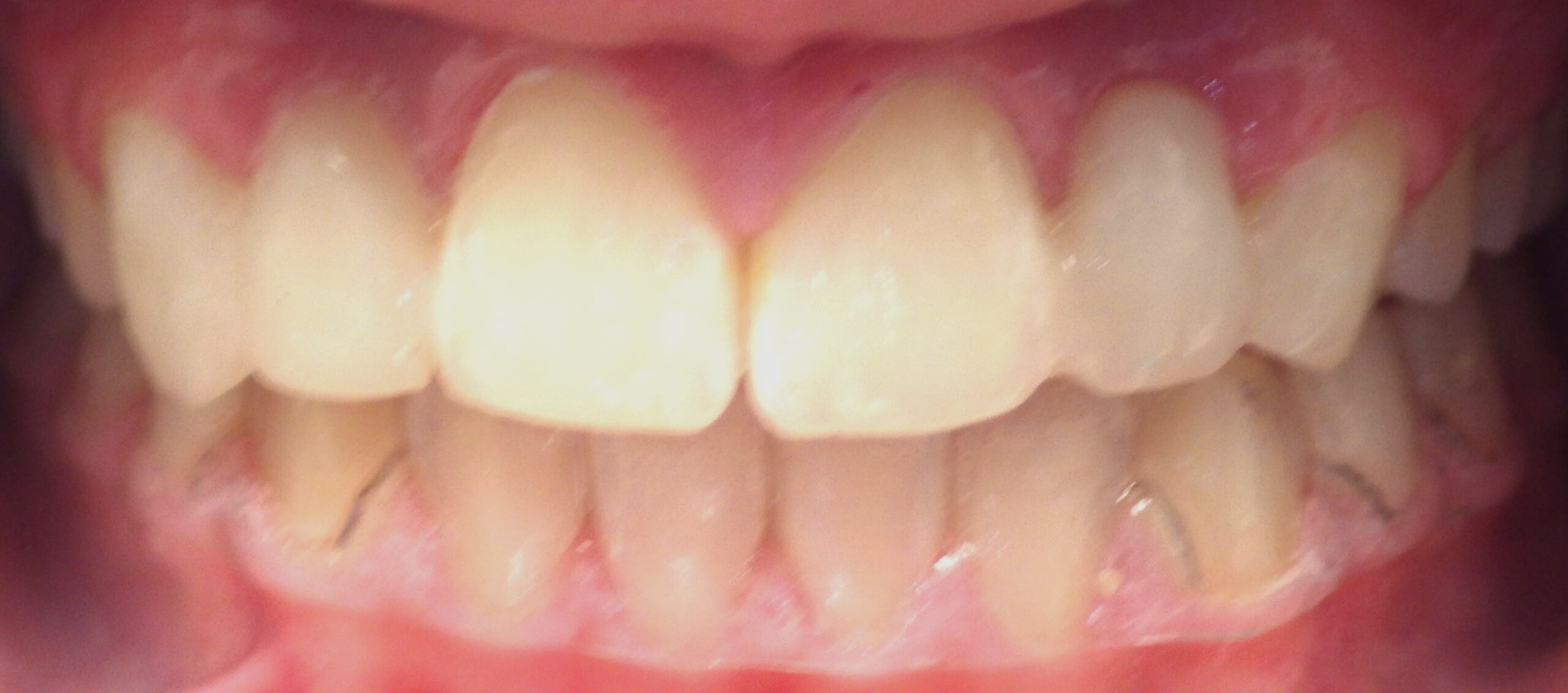 The results after replacing missing teeth at Mango Dental in Greensboro, NC.
