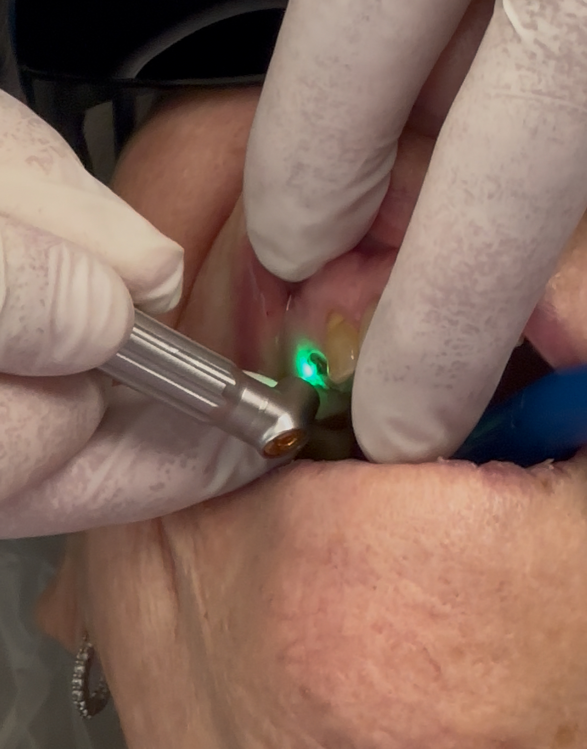 Laser Fillings in Greensboro NC