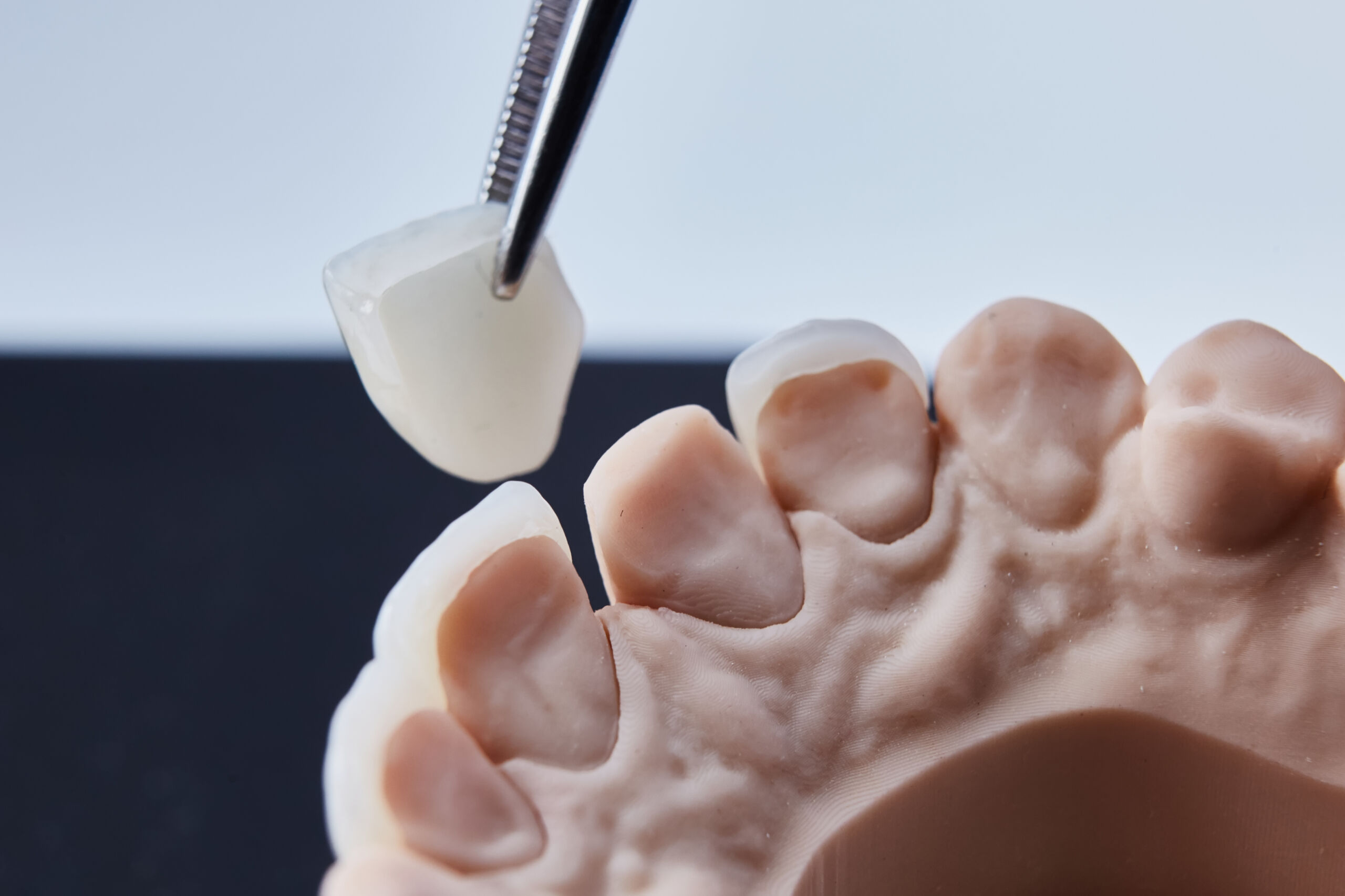 Close-up of a dental tool placing a tooth crown onto a prepared tooth