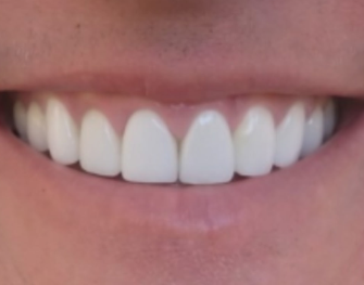 Close-up of a smiling mouth showing white teeth and pink lips.