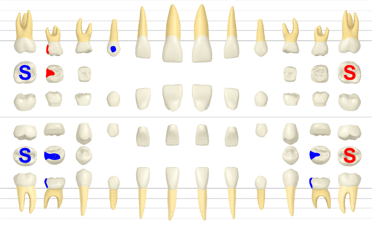 3D dental model showing upper and lower teeth with blue/red markers and 'S' labels on several molars, for educational reference.