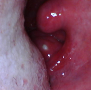 Close-up of a red inflamed throat tissue with a small white bump near the tonsil.