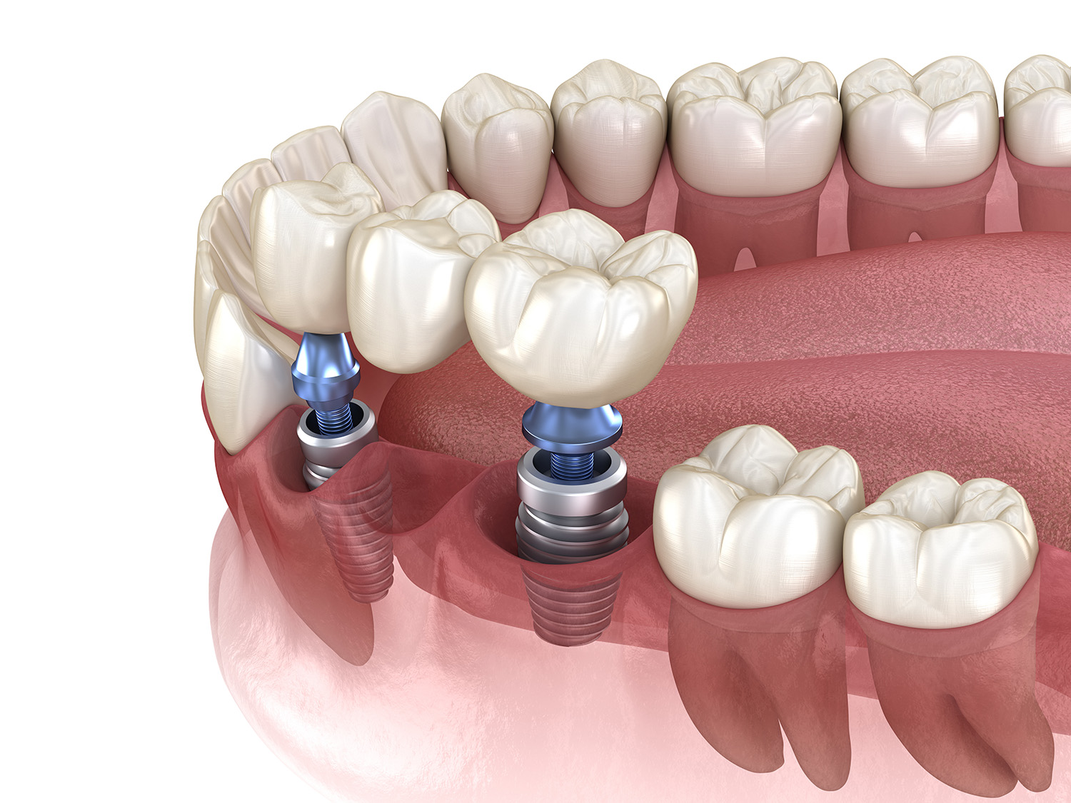 Implants holding a bridge small - MANGO DENTAL Dental Implants at Mango Dental in Greensboro NC